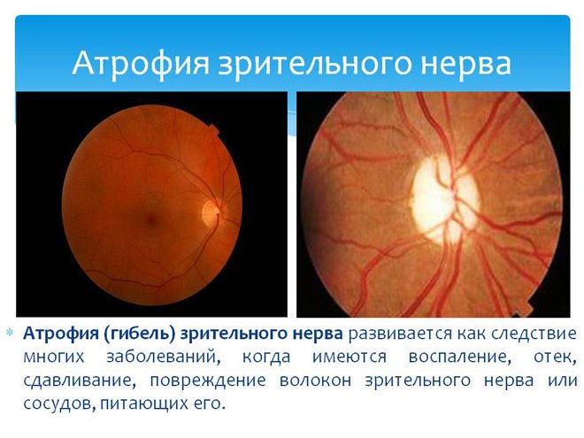 Атрофия