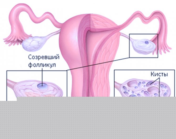 ЭКО при СПКЯ