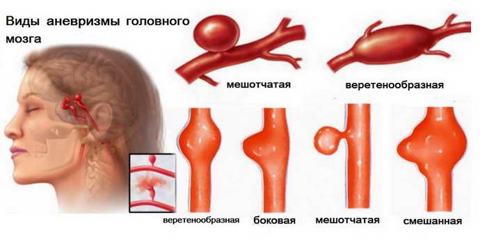 Гидроцефалия окклюзионная у деетей
