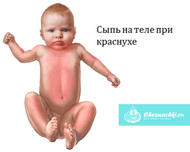 как распределяется сыпь при краснухе