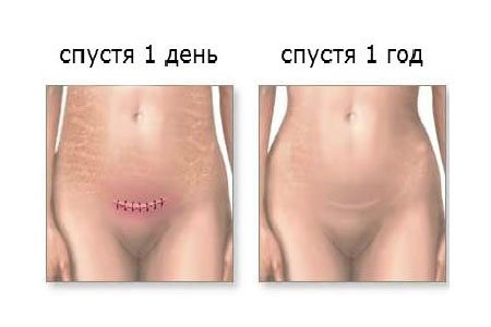 Лапаротомическое удаление новообразования