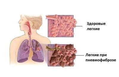 Пневмофиброз