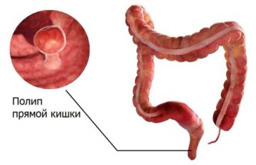 полип прямой кишки