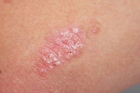 псориаз фото начальной стадии на руке