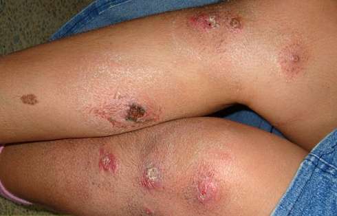 раны на ногах