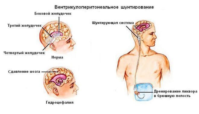 шунтирование при гидроцефалии