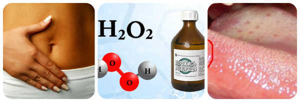 Спринцевание перекисью водорода: эффективный метод лечения молочницы