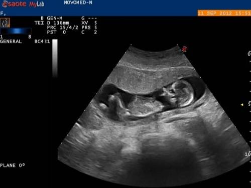 УЗИ при волчьей губе