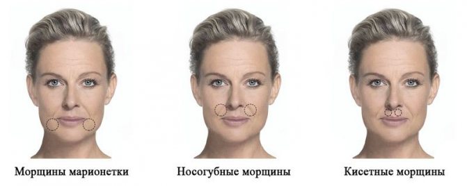 Виды морщин вокруг рта