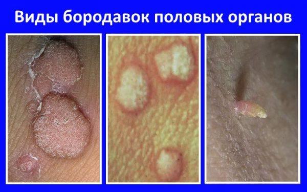 Виды половых бородавок
