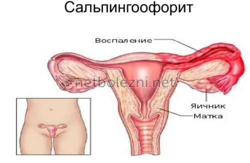 Воспаление женских органов